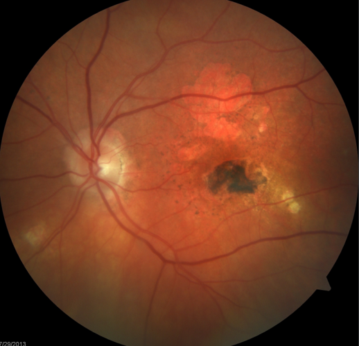 Wet Macular Degeneration Treated