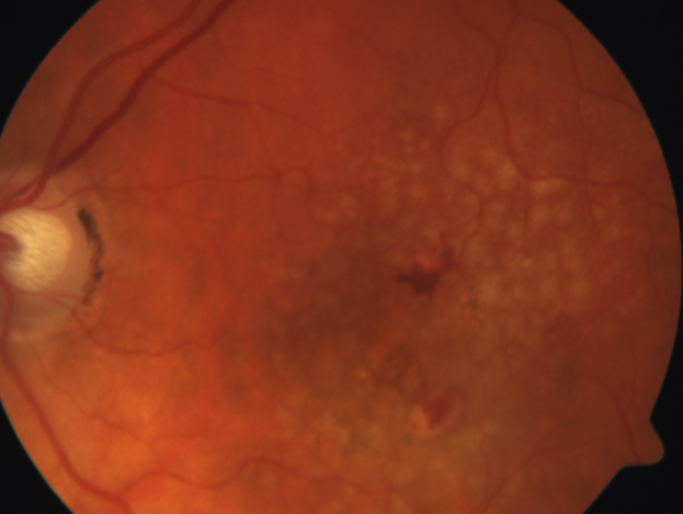 Wet Macular Degeneration