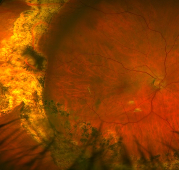 Retinal Detachment Treated