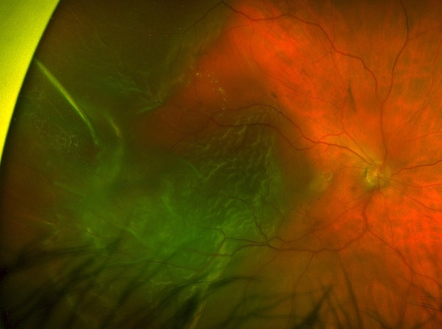 Retinal Detachment Fundus