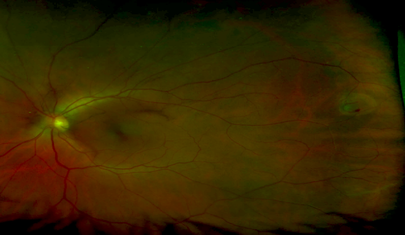 Retinal Tear Associated Retinal Consultants P C